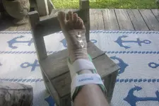 ankle sprain 004.webp