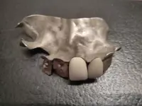 denture3.webp