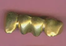 22K_Gold_Teeth.webp