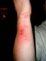 poison oak.webp