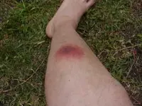 spider bite.webp